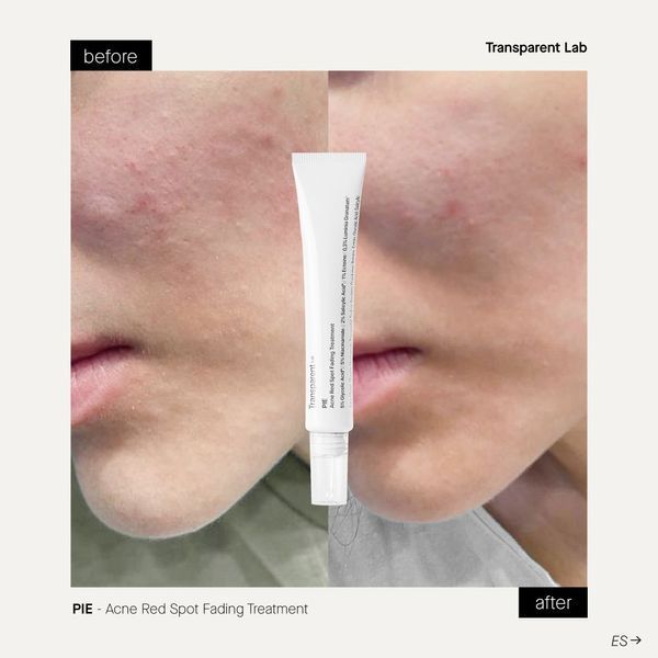 Transparent Lab Pie Acne Red Spot Fading Treatment Засіб для боротьби із постзапальною пігментацією, 30мл 1869 фото