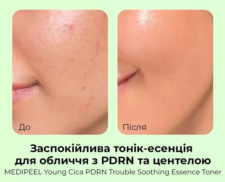 Medi-Peel Young Cica PDRN Trouble Soothing Essence Toner Заспокійливий тонер-есенція для обличчя, 200мл 1975 фото
