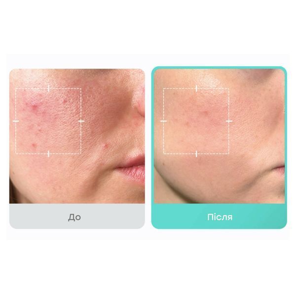Medicube Azelaic Acid 16 BB Calming Serum Заспокійлива сироватка з азелаїновою кислотою 16%, 30мл 2520 фото