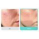 Medicube Azelaic Acid 16 BB Calming Serum Заспокійлива сироватка з азелаїновою кислотою 16%, 30мл 2520 фото 4