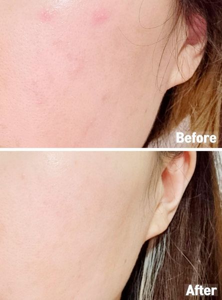 J'sDerma Acnetrix Control AC Serum Заспокійлива сироватка для проблемної шкіри обличчя, 30мл 1421 фото