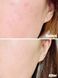 J'sDerma Acnetrix Control AC Serum Заспокійлива сироватка для проблемної шкіри обличчя, 30мл 1421 фото 6