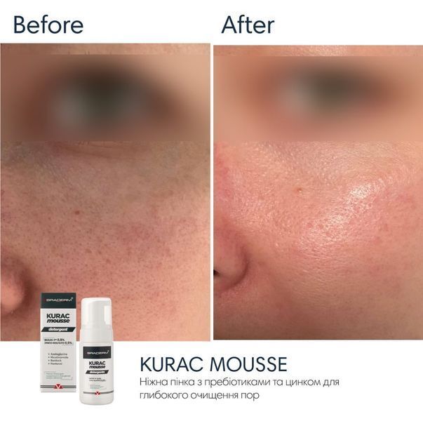 Braderm Kurac Cleansing Mousse Пінка для вмивання, 100мл 1804 фото