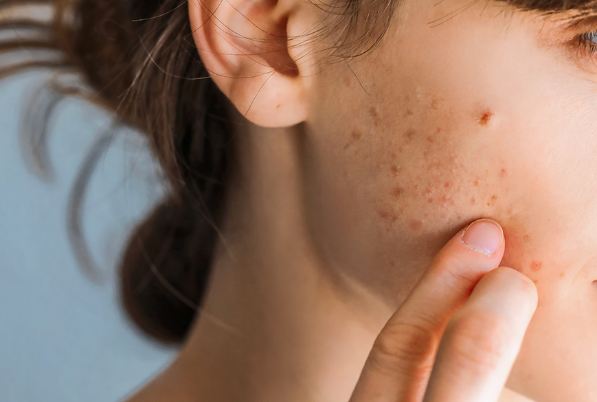 Derma Factory Clay 2% Acne Cleansing Bar Очищуючий засіб для жирної та проблемної шкіри 3 в 1, 100г 2780 фото