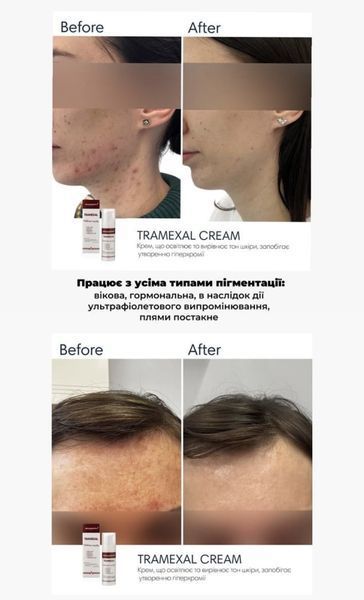 Braderm Tramexal Cream Освітлюючий крем проти пігментації, 30мл 1808 фото